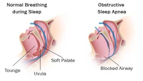 What is Sleep Apnea - The Ultimate Guide